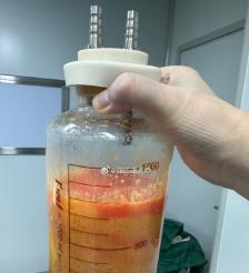 章丘水动力吸脂手术要做多久？